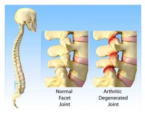 Cấu trúc một khớp bề mặt bình thường và một khớp bề mặt bị thoái hóa