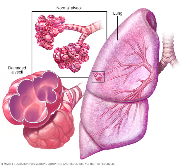 vật lý trị liệu tại nhà bệnh copd