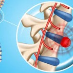 VẬT LÝ TRỊ LIỆU THOÁT VỊ ĐĨA ĐỆM
