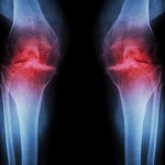 VẬT LÝ TRỊ LIỆU VIÊM KHỚP