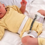 VẬT LÝ TRỊ LIỆU PHỤC HỒI CHỨC NĂNG TRẬT KHỚP HÁNG BẨM SINH