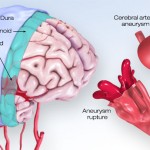 PHÌNH MẠCH MÁU NÃO VÀ PHƯƠNG PHÁP ĐIỀU TRỊ