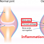 REHABILITATION SERVICE FOR DEGENERATIVE JOINT DISEASE