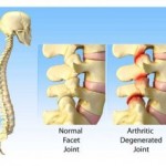 BỆNH LÝ THOÁI HÓA CỘT SỐNG NGUYÊN NHÂN TỪ BỀ MẶT KHỚP