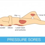 VẬT LÝ TRỊ LIỆU LOÉT DO TÌ ĐÈ