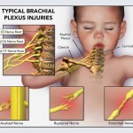 VẬT LÝ TRỊ LIỆU TỔN THƯƠNG ĐÁM RỐI CÁNH TAY