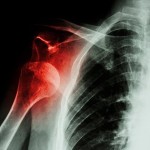 VẬT LÝ TRỊ LIỆU TRẬT KHỚP VAI