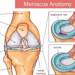 VẬT LÝ TRỊ LIỆU RÁCH SỤN CHÊM