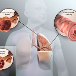 PHỤC HỒI CHỨC NĂNG BỆNH COPD
