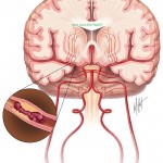 ĐIỀU TRỊ ĐỘT QUỴ