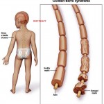VẬT LÝ TRỊ LIỆU TẠI NHÀ HỘI CHỨNG GUILLAIN – BARRÉ