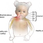 VẬT LÝ TRỊ LIỆU PHỤC HỒI CHỨC NĂNG CHO TRẺ LIỆT MỀM TRONG TỔN THƯƠNG THẦN KINH NGOẠI BIÊN