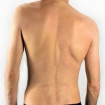 VẬT LÝ TRỊ LIỆU VẸO CỘT SỐNG