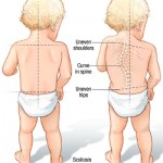 VẬT LÝ TRỊ LIỆU PHỤC HỐI CHỨC NĂNG CHO TRẺ BỊ CONG VẸO CỘT SỐNG