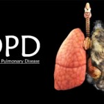 VẬT LÝ TRỊ LIỆU BỆNH PHỔI TẮC NGHẼN MÃN TÍNH (COPD) TẠI NHÀ