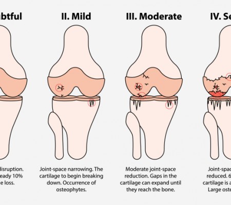 ĐIỀU TRỊ ĐAU KHỚP GỐI MÃN TÍNH