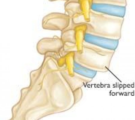 VẬT LÝ TRỊ LIỆU TRƯỢT ĐỐT SỐNG THẮT LƯNG